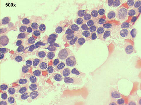 500x Papanicolaou staining, field with numerous lymphocytes