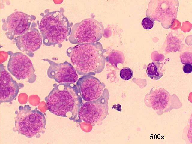 M-G-G staining, notice the lipid vacuoles