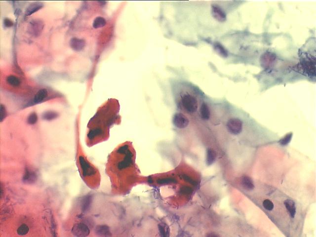 Atypical highly keratinized squamous cells (atypical parakeratosis) 500x Pap staining