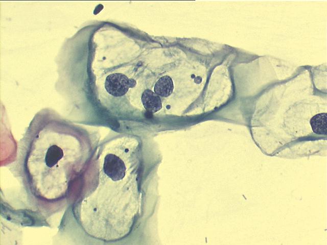 Koilocytes 500x Pap staining, perinuclear cavitation and nuclear abnormalities