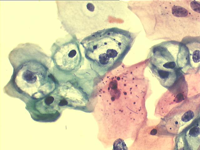 500x Pap staining high power view of previous image