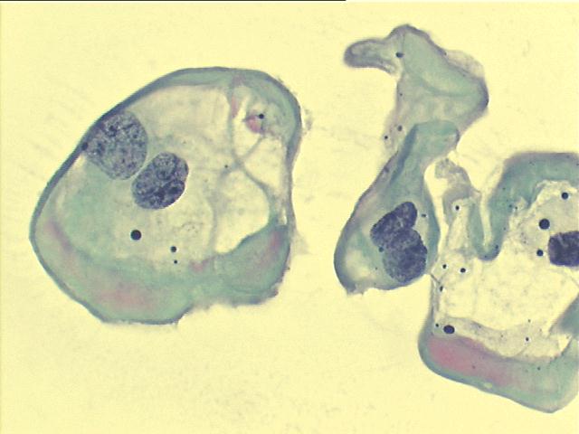 Koilocytes 500x Pap staining, perinuclear cavitation and nuclear abnormalities