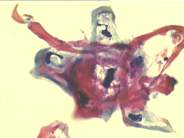 Large amphophilic koilocytes 500x Pap staining