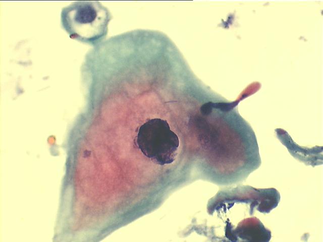 Large abnormal amphophilic squamous cell 500x Pap staining