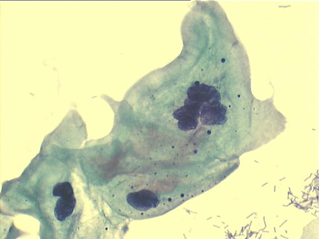 Large multinucleated abnormal squamous cell, 500x Pap staining