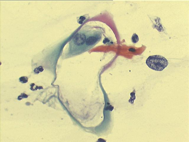 Koilocyte 500x Pap staining, large empty koilocyte