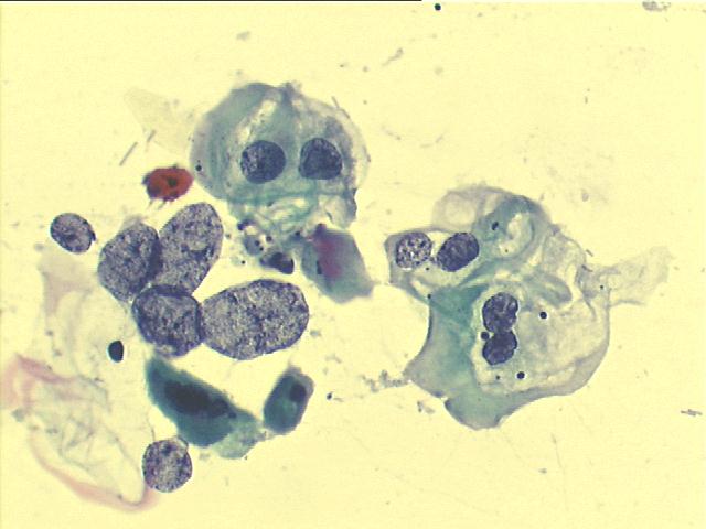 Koilocytes 500x Pap staining, perinuclear cavitation and nuclear abnormalities, some large bare abnormal nuclei