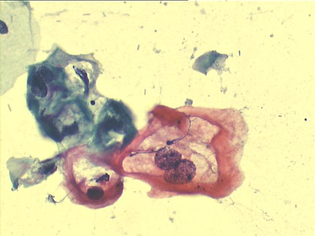 Koilocytes 500x Pap staining, perinuclear cavitation and nuclear abnormalities