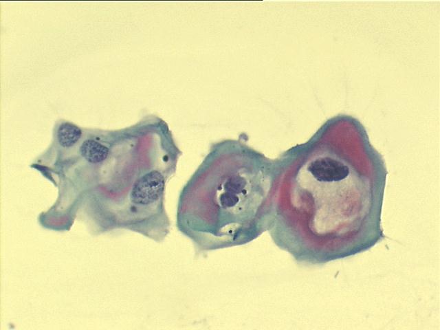 Koilocytes 500x Pap staining, perinuclear cavitation and nuclear abnormalities