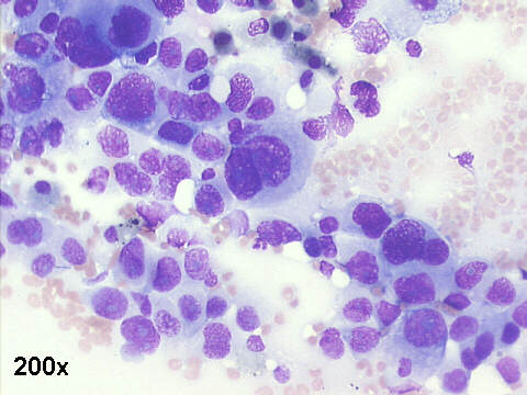 Adenocarcinoma metastasis from lung, 200x M-G-G staining