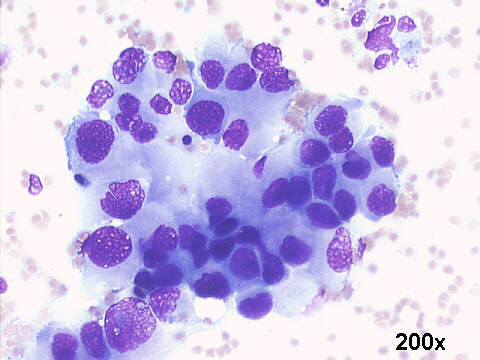 Adenocarcinoma metastasis from lung, 200x M-G-G staining 