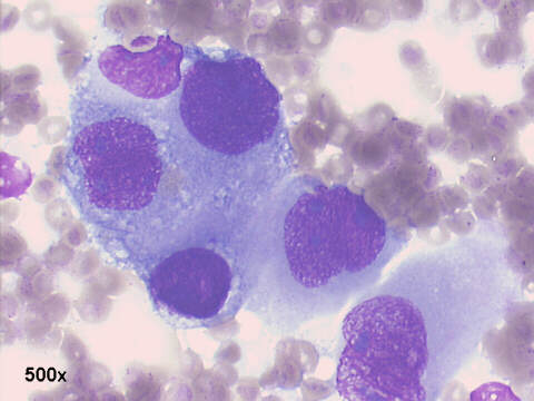 Adenocarcinoma metastasis from lung, 500x M-G-G staining, acinar pattern, with peripheral location of the nuclei