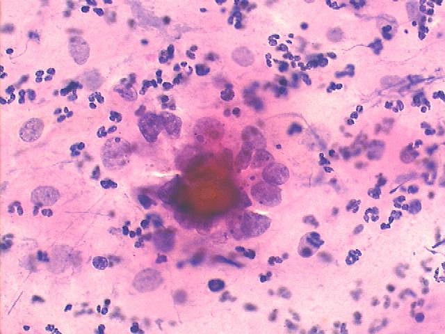 Papillary serous ovarian carcinoma with many psammoma bodies, Pap staining