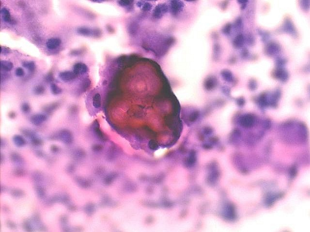 Papillary serous ovarian carcinoma with many psammoma bodies, Pap staining