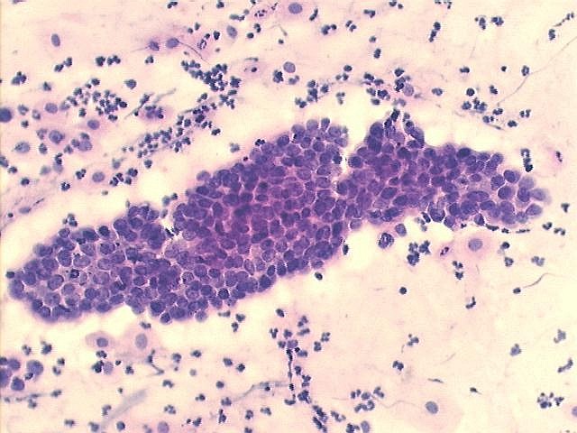 Papillary serous ovarian carcinoma with many psammoma bodies, Pap staining