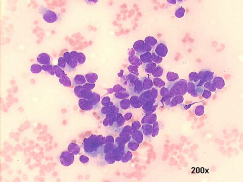 Carcinoma of the kidney, with papillary differentiation, 200x, M-G-G staining, 20x oil objective lens