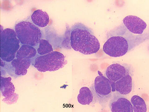 Carcinoma of the kidney, with papillary differentiation, 500x M-G-G staining