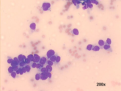 Carcinoma of the kidney, with papillary differentiation, 200x M-G-G  staining, 20x oil objective lens