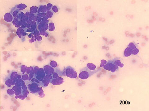 Carcinoma of the kidney, with papillary differentiation, 200x M-G-G staining, 20x oil objective lens