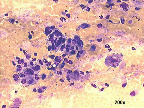Poorly differentiated ductal carcinoma 200x M-G-G staining, 20x oil objective lens