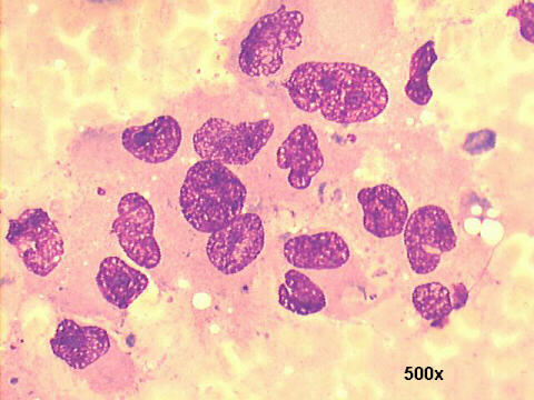 Poorly differentiated ductal carcinoma 500x M-G-G staining