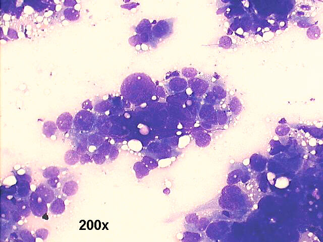 200x M-G-G  staining, adrenal carcinoma