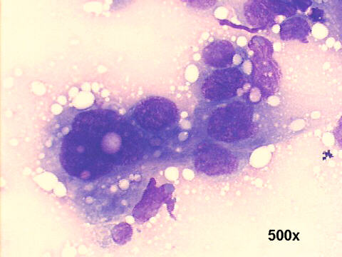 500x M-G-G staining, adrenal carcinoma