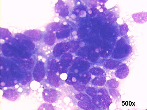 500x M-G-G staining, adrenal carcinoma
