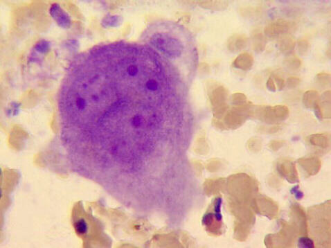 FNA of breast mass, M-G-G staining 500x