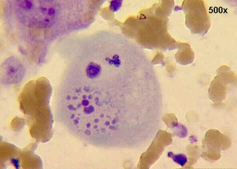 FNA of breast mass, M-G-G staining 500x