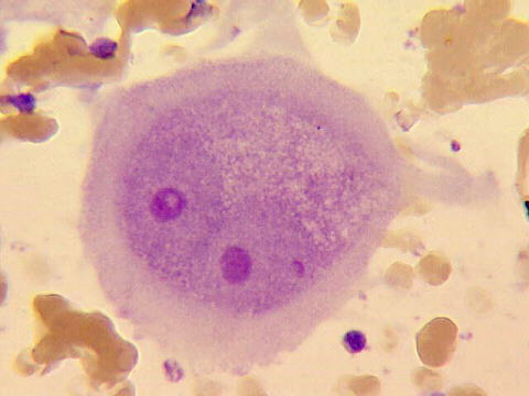 FNA of breast mass, M-G-G staining 500x