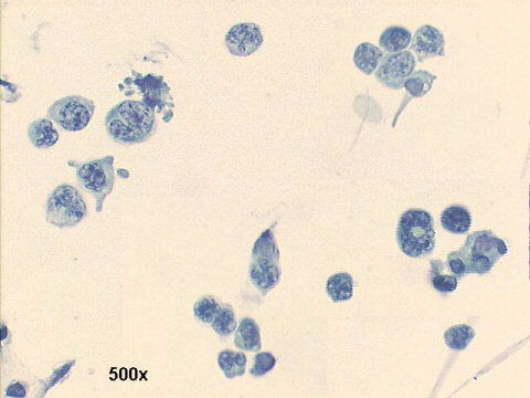 Sezary cells, 500x oil Pap staining