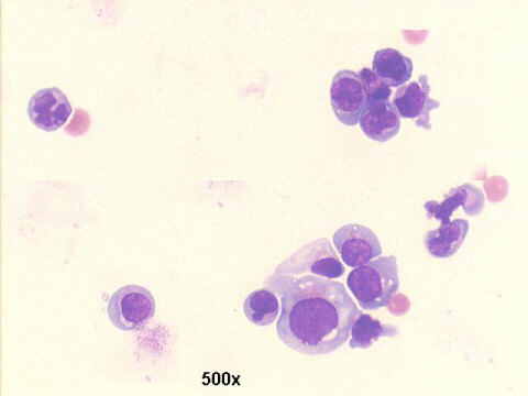 Sezary cells, 500x M-G-G staining