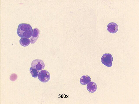 Sezary cells, 500x M-G-G staining