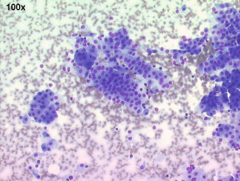 Lung oncocytoma 100x M-G-G staining