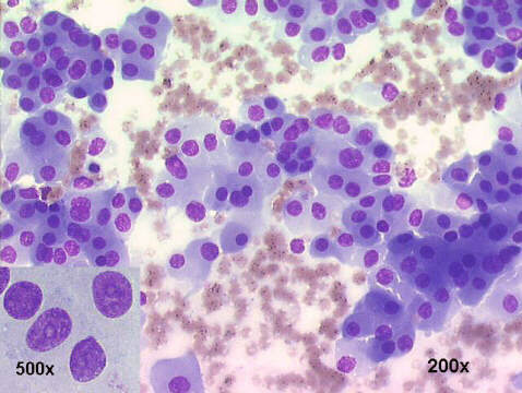 Lung oncocytoma 200x M-G-G staining