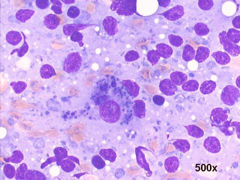 Hashimoto thyroiditis 500x M-G-G staining, numerous lymphoid cells, large dendritic cell