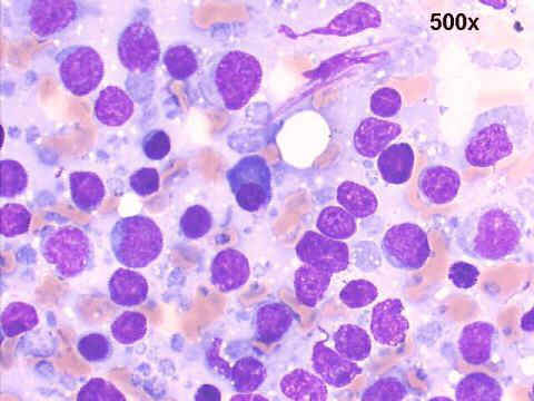 Hashimoto thyroiditis 500x M-G-G staining, numerous lymphoid cells