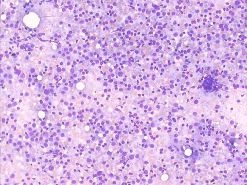 Hashimoto thyroiditis 100x M-G-G staining, numerous lymphoid cells