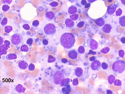 Hashimoto thyroiditis, numerous lymphoid cells 500x M-G-G staining