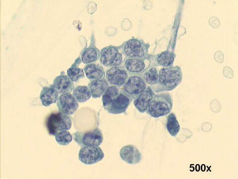 Lymphoblastic lymphoma 500x Pap staining