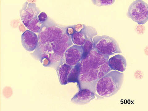 Lymphoblastic lymphoma: 500x M-G-G staining