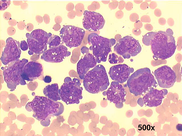 Mediastinal lymphoma, 500x M-G-G staining, large lymphoid cells with prominent nucleoli and small lipid vacuoles