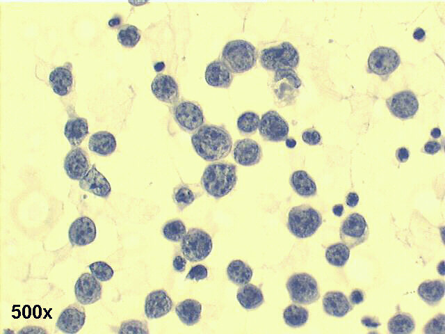 Mediastinal lymphoma, 500x Pap staining