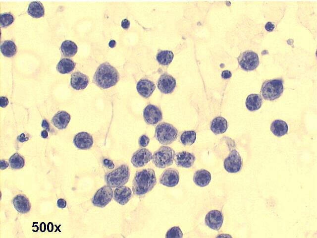 Mediastinal lymphoma, 500x Pap staining,