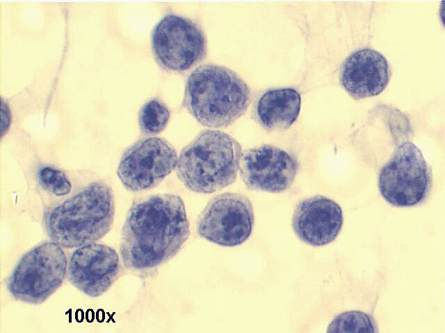 Mediastinal lymphoma, 1000x Pap staining, the coarse chromatin is evident.