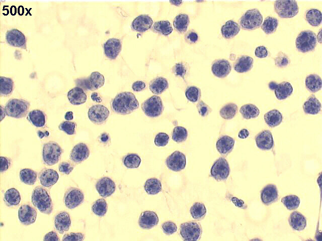 Mediastinal lymphoma, 500x Pap staining, coarse chromatin of large blast cells