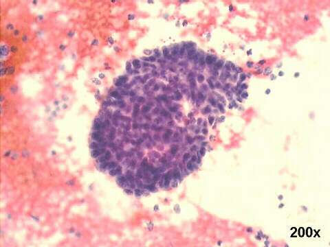 Group of adenocarcinoma cells 200x Pap staining