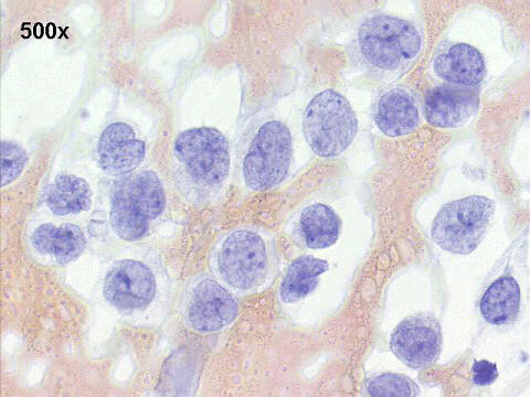 Papanicolaou staining, 1,000x AML blast cells