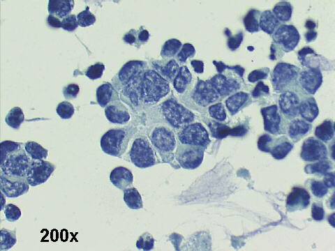 200x Papanicolaou staining - see rosettelike formation